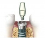 アバットメント（支台）の装着